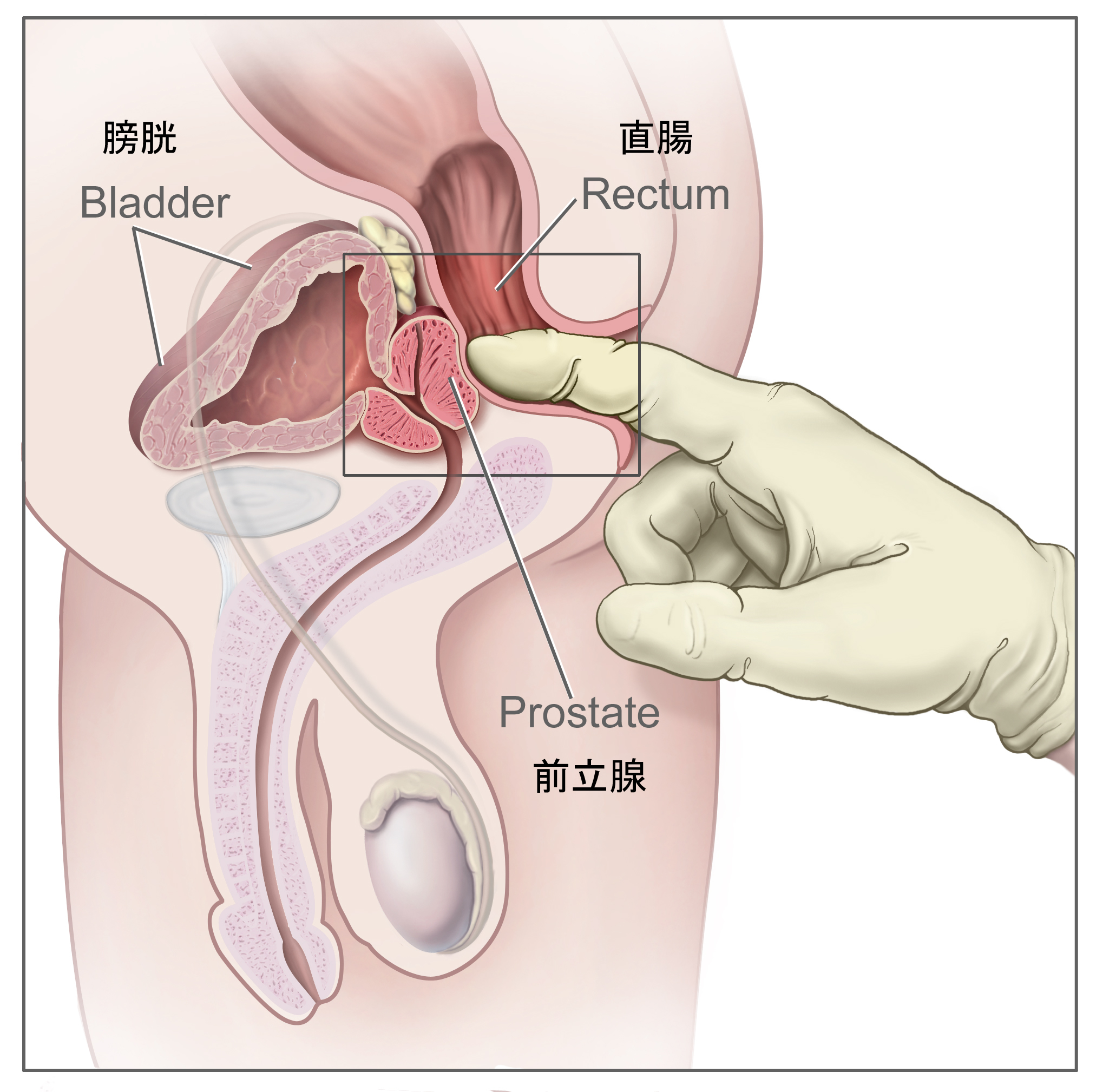 reasons du cancer du larynx