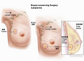 乳房温存手術：図は切除される腫瘍と腋窩リンパ節の範囲を示す。