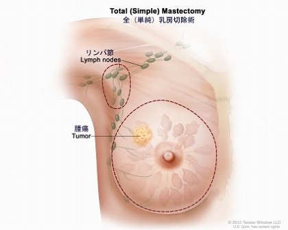 乳房全摘出術（単純乳房切除術）：図は切除される乳房とリンパ節の範囲を示す。