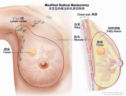 非定型的根治的乳房切除術。左図は、乳房、わきの下のリンパ節の大半または全部、胸筋を覆う膜、胸壁の筋肉の一部（場合による）の切除範囲を示している。右図は乳房の断面図で、胸壁（肋骨と筋肉）、脂肪組織、腫瘍を示している。