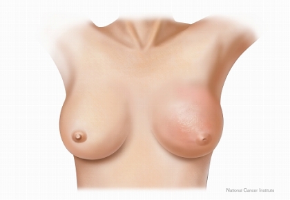 橙皮状皮膚および陥没乳頭を伴う左胸の炎症性乳がん。