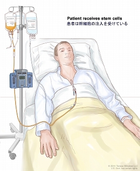 図は患者の胸部に挿入されたカテーテルから幹細胞を注入しているところである。