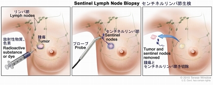乳房のセンチネルリンパ節生検。3枚のうち、1枚目の図は腫瘍付近に注入された放射性物質または青い色素を示す；2枚目の図は注入した物質を視覚的にまたは放射線を検知するプローブで確認し、センチネルリンパ節（注入した物質を含んでいる最初のリンパ節）を特定する段階を示す；3枚目の図は腫瘍とセンチネルリンパ節を摘出してがん細胞の有無を調べる段階を示す。