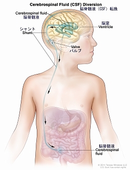 脳脊髄液（CSF）転換：図は、余分なCSFをチューブ（シャント）で脳室から腹部に排出する様子を示している。シャントは脳室から頸部と胸部の皮膚の下を通って腹部に達している。CSFの流れを調節する弁も示されている。