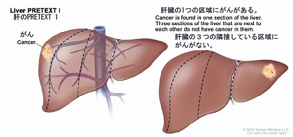 肝のPRETEXT 1；2種類の肝臓を示す。それぞれ、縦の点線で肝臓を4つの区画に分けて、ほぼ同じ大きさになるようにしている。1番目の肝臓では、左端の区域にがんがある。2番目の肝臓では、右端の区域にがんがある。