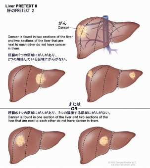 肝のPRETEXT 2；5種類の肝臓を示す。それぞれ、縦の点線で肝臓を4つの区画に分けて、ほぼ同じ大きさになるようにしている。1番目の肝臓では、左側の2つの区域にがんがある。2番目の肝臓では、右側の2つの区域にがんがある。3番目の肝臓では、左端と右端の区域にがんがある。4番目の肝臓では、左から2番目の区域にがんがある。5番目の肝臓では、右から2番目の区域にがんがある。
