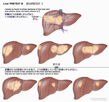 肝のPRETEXT 3；7種類の肝臓を示す。それぞれ、縦の点線で肝臓を4つの区画に分けて、ほぼ同じ大きさになるようにしている。1番目の肝臓では、左側の3つの区域にがんがある。2番目の肝臓では、左側の2つの区域と右端の区域にがんがある。3番目の肝臓では、左端の区域と右側の2つの区域にがんがある。4番目の肝臓では、右側の3つの区域にがんがある。5番目の肝臓では、中央の2つの区域にがんがある。6番目の肝臓では、左端の区域と右から2番目の区域にがんがある。7番目の肝臓では、右端の区域と左から2番目の区域にがんがある。