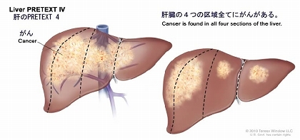 肝のPRETEXT 4；2種類の肝臓を示す。それぞれ、縦の点線で肝臓を4つの区画に分けて、ほぼ同じ大きさになるようにしている。1番目の肝臓では、4つの区域すべてにがんがある。2番目の肝臓では、左側の2つの区域にがんがあり、右側の2つの区域には塊状のがんがある。