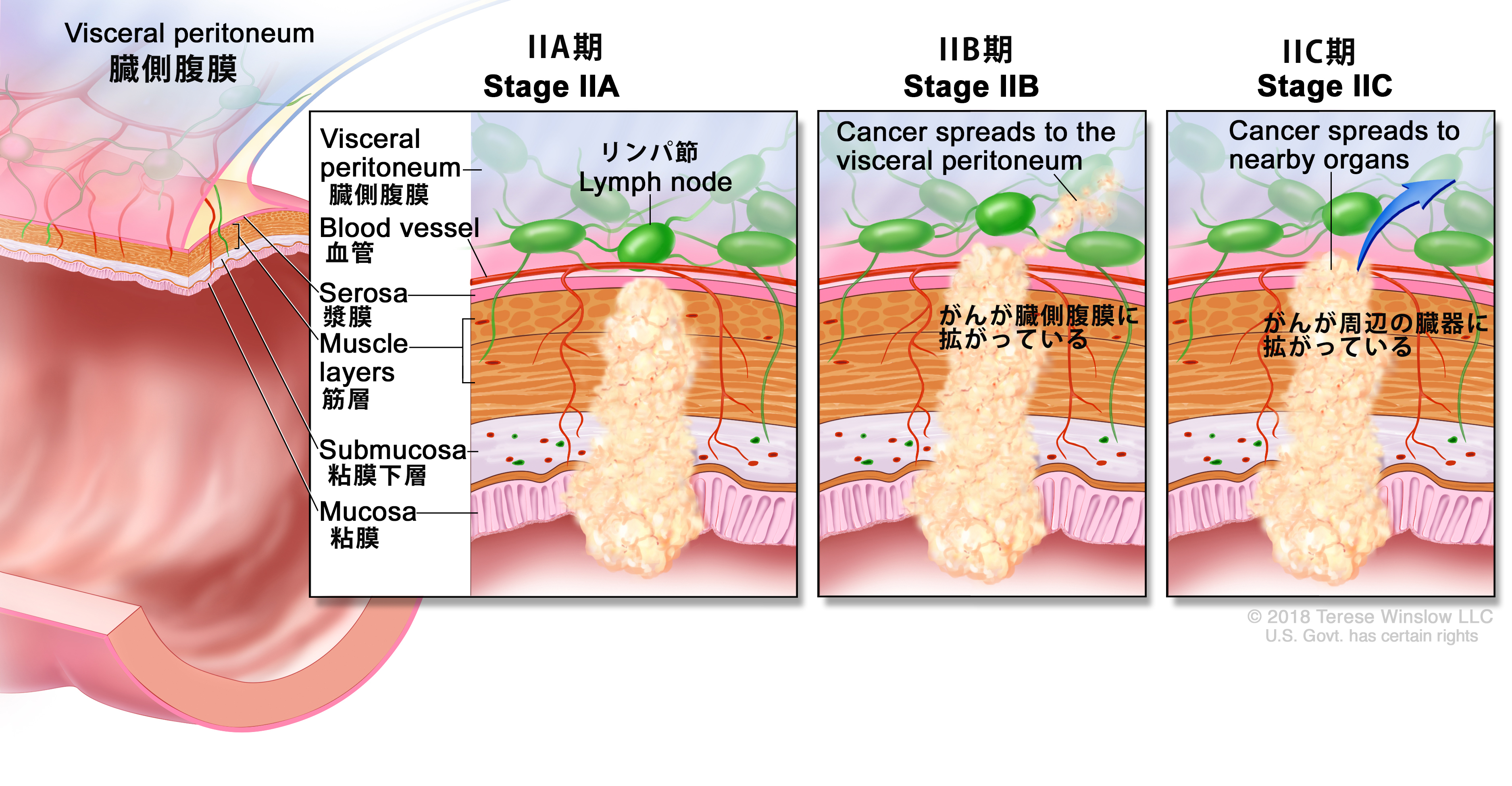 結腸直腸がんはどのように病期分類されますか?