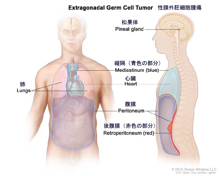 がん情報サイト がん情報各論 患者さん向け 性腺外胚細胞腫瘍の治療 Pdq